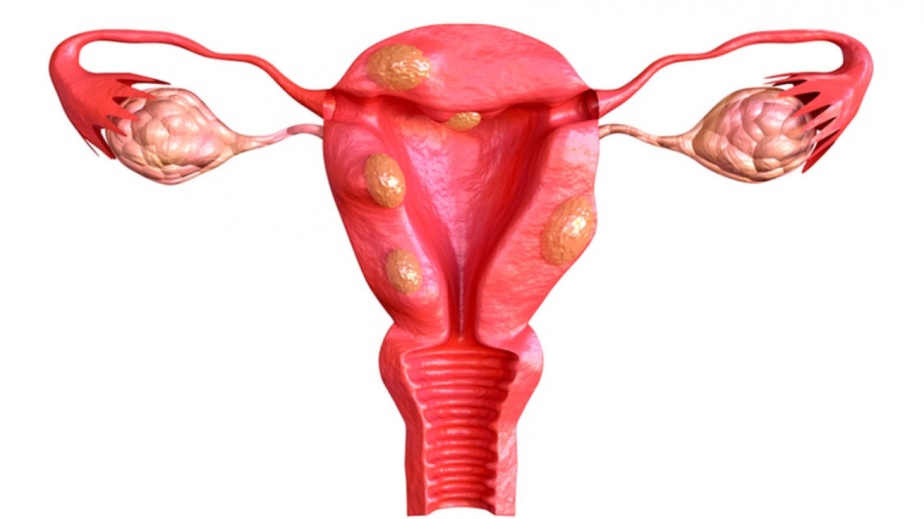 Miomas-tem-que-ser-tratados-com-cirurgia