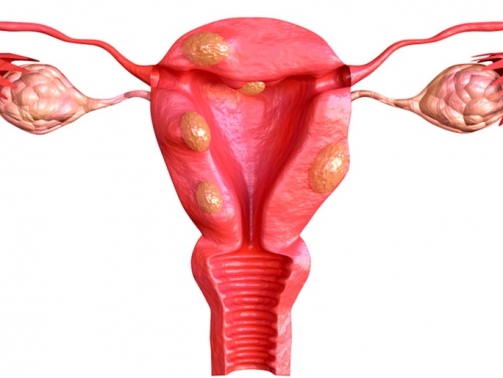 Miomas-tem-que-ser-tratados-com-cirurgia